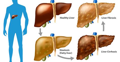 NAFLD and NASH |Nonalcoholic Fatty Liver Disease (NAFLD) and NASH