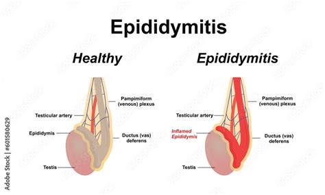 Epididymitis is inflammation of the epididymis of the testicle. Stock Vector | Adobe Stock