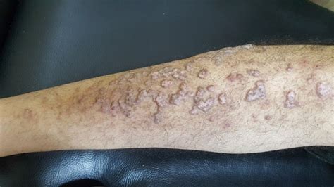 Dermatology Made Easy: Nummular Eczema