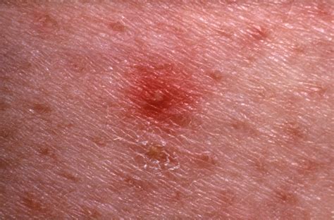 7 Causes of Red Spots and Bumps on Skin, With Pictures | Allure