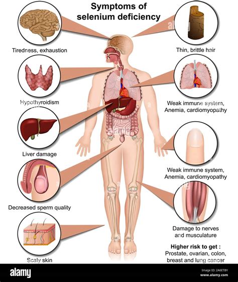 What are the symptoms of selenium deficiency? [2022] | QAQooking.wiki