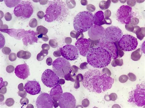 Bone marrow aspirate shows numerous highly granular promyelocytes ...