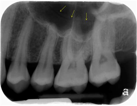 intraoral radiograph anatomy – Page 3 – Dr. G's Toothpix