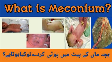 Baby stool pass inside womb/Baby poti/what is Meconium/Meconium ...