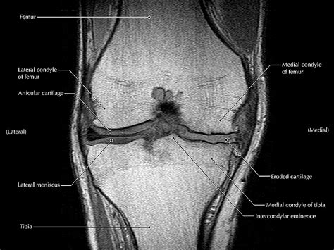 Can MRI Predict Worsening Knee Symptoms and Joint Damage?