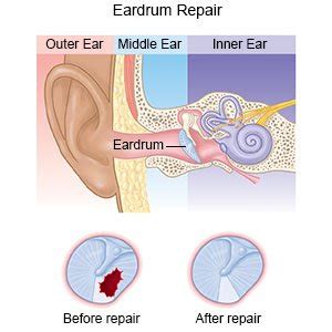 what is myringoplasty