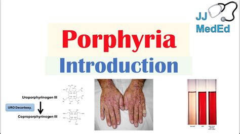 Porphyria Cutanea Tarda Pathway