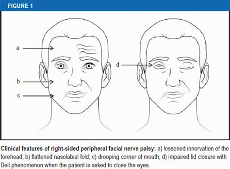 The Diagnosis and Treatment of Idiopathic Facial Paresis (Bell’s Palsy) (11.10.2019)