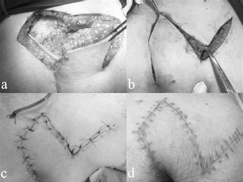 Figure 1 from Retrospective review of pilonidal sinus patients with ...