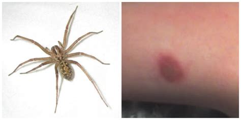 How to Identify a Spider Bite and Treat It | TruePrepper