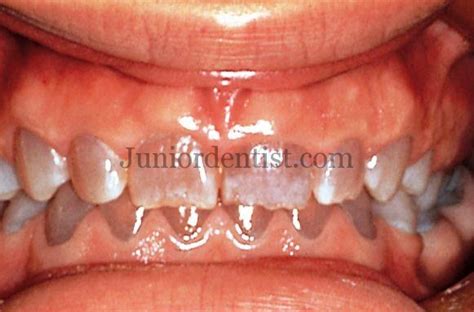 Osteogenesis Imperfecta - Clinical Features, Types, Radiographic ...