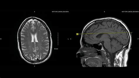 Axial Brain Mri