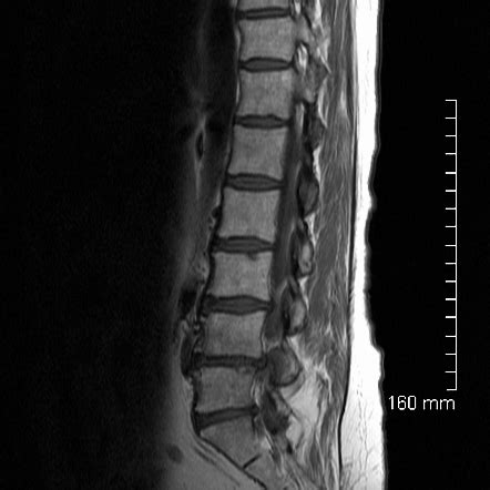 Lipoma of filum terminale | Radiology Case | Radiopaedia.org