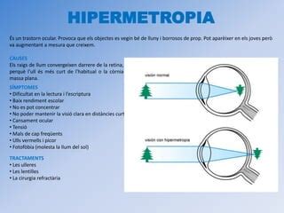 Trastorns de la vista | PPT