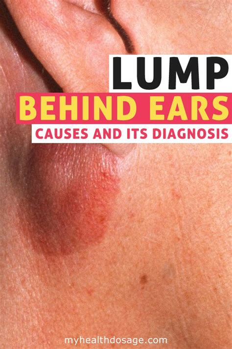 What Causes Lumps Behind the Ears? What to do when you have a lump behind your ear | Lump behind ...