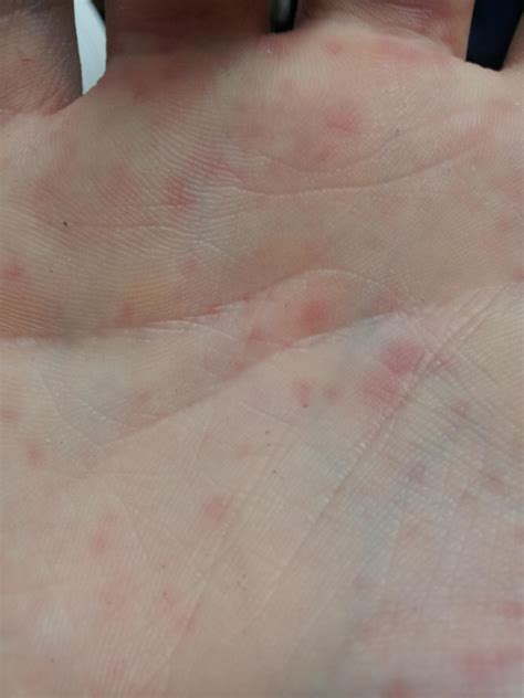 hey I just discovered a lot of red spots on my hands (wrist