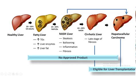 ESTEATOSIS HEPATICA - YouTube