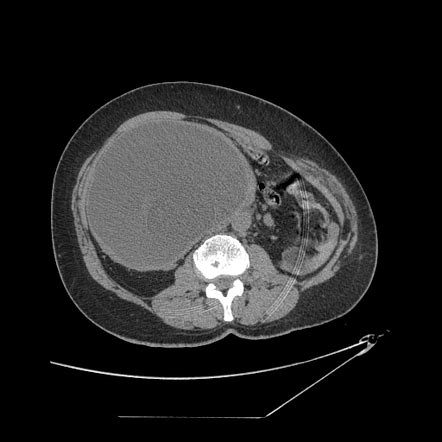 Paraganglioma | Radiology Reference Article | Radiopaedia.org