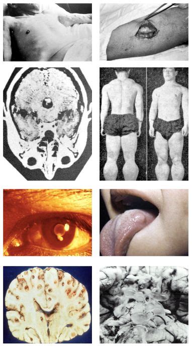 Epidemiology of Neurocysticercosis in Mexico: From a Public Health ...