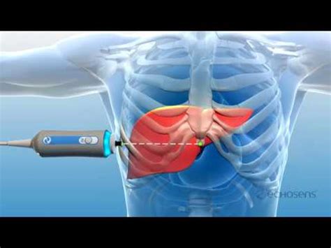 The FibroScan Technology - YouTube