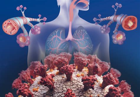 Asthma Associated With Comparable Risk of Hospitalization in COVID-19 - Infectious Disease Advisor