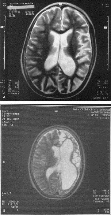 Rasmussen syndrome and long-term response to thalidomide - Pediatric ...