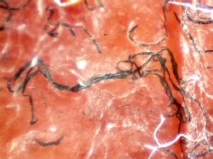 What are Morgellons Fibers? - Charles E. Holman Foundation