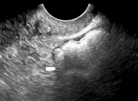 Ultrasound example of bowel. Grayscale transvaginal ultrasound image of... | Download Scientific ...