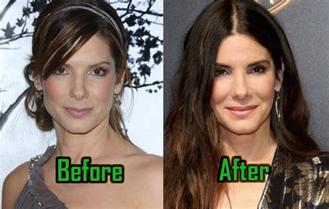 Sandra Bullock: Plastic Surgery Changed Her Nose? Before-After! | CelebritySurgeryIcon