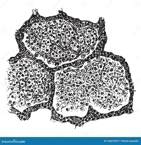 Fibrinous Exudate Stock Illustrations – 3 Fibrinous Exudate Stock Illustrations, Vectors ...