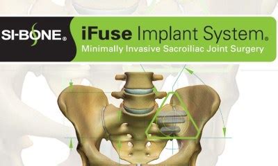 SI-BONE, Minimally Invasive SI Joint Fusion using the iFuse Implant ...