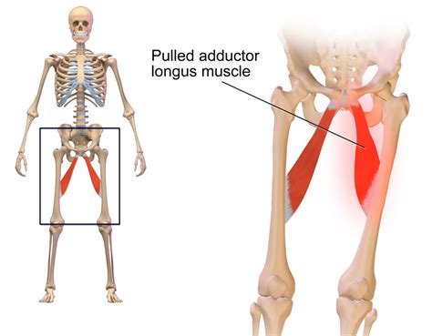 Pérégrination Vide Tombeau pulled groin muscle pain Se ruiner outre le ...