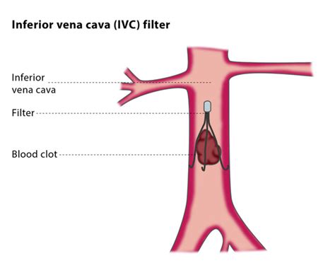 Inferior Vena Cava(IVC) Filter Placement, Benefits & Risks » How To Relief