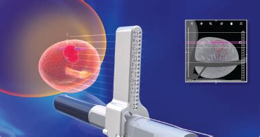 Transrectal Biopsy Diagnostic : Procedure And Side Effects