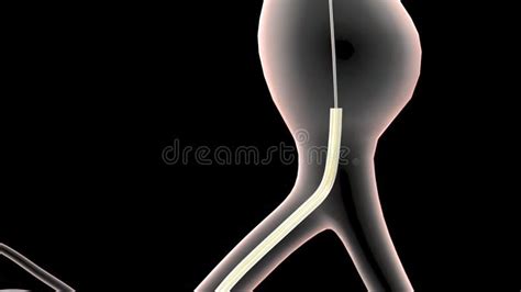 Abdominal Aortic Aneurysm Treatment Stock Illustration - Illustration ...