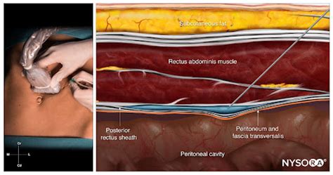 Rectus Sheath Block in 4 Steps - NYSORA | NYSORA