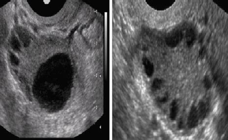 Polycystic Ovary Syndrome (PCOS) - Dr. Sita Sharma | MBBS, MD (OBSTETRICS AND GYNECOLOGY)