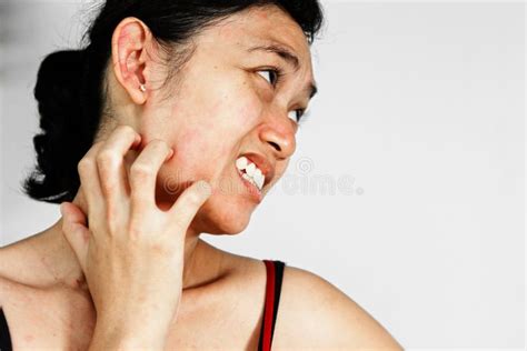 Woman Scratch Face with Skin Rash Stock Photo - Image of face, asian ...