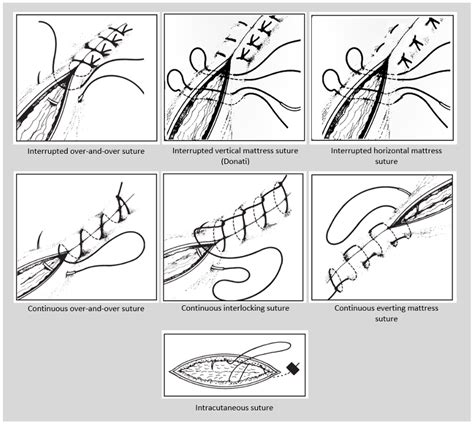 Suturing technique | OSCEstop | OSCE Learning