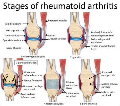 Rheumatoid Arthritis - Causes, Signs, Symptoms, Diet, Treatment