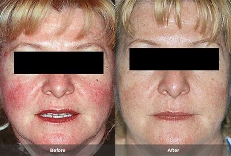 Rosacea Treatment Photos | Rosacea.org