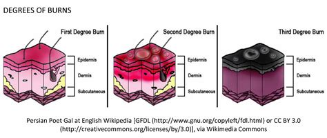 Burns | Health and Above