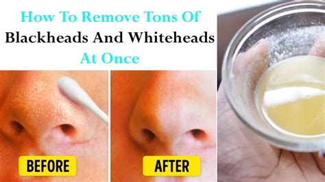 How to Remove Tons of Blackheads and Whiteheads Instantly! Home Remedies Remedies - YouTube