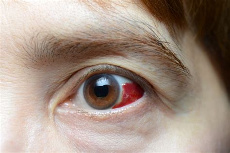 Blood Clot In Eye Due To Diabetes - DiabetesWalls