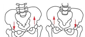 Lateral Pelvic tilt (Left vs Right pelvic tilt): Causes, Treatment