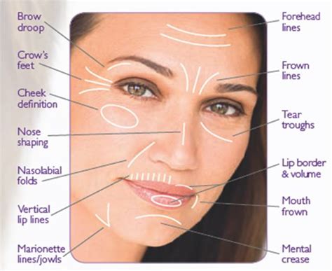 wrinkles | Face fillers, Nasolabial folds, Dermal fillers