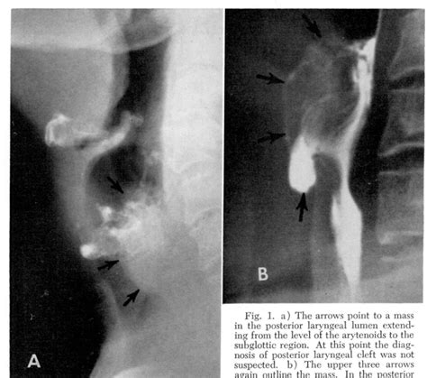 Figure 1 from Congenital Laryngeal Defects in the Adult | Semantic Scholar