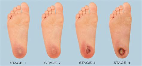 Diabetic Foot Ulceration - Quality Foot Care