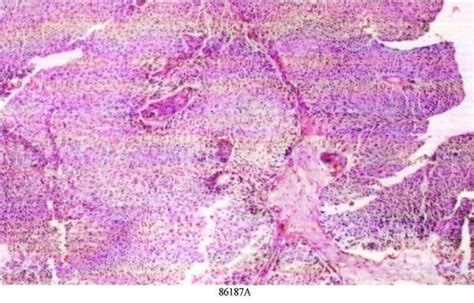 Histological features of transitional cell carcinoma | Download ...