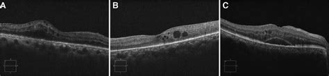 Different types of DME by OCT. (A) DRT type: sponge-like swelling of... | Download Scientific ...